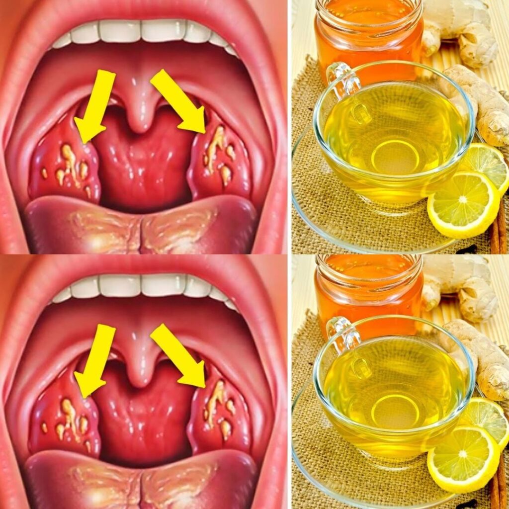 Relieve tonsillitis naturally: A herbal honey remedy