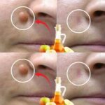 APPLE CIDER VINEGAR removes warts in 24 hours! Just do the following…