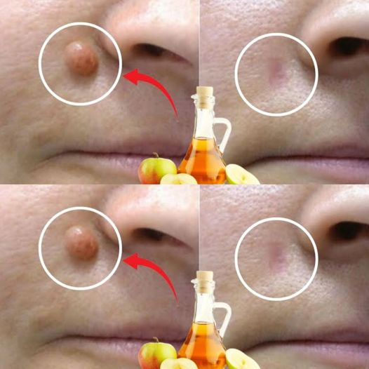 APPLE CIDER VINEGAR removes warts in 24 hours! Just do the following…
