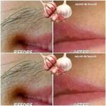 Say goodbye to unwanted hair with garlic.