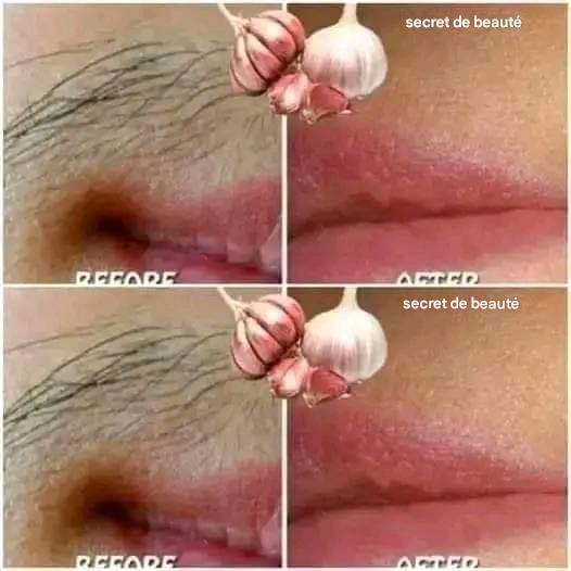 Say goodbye to unwanted hair with garlic.