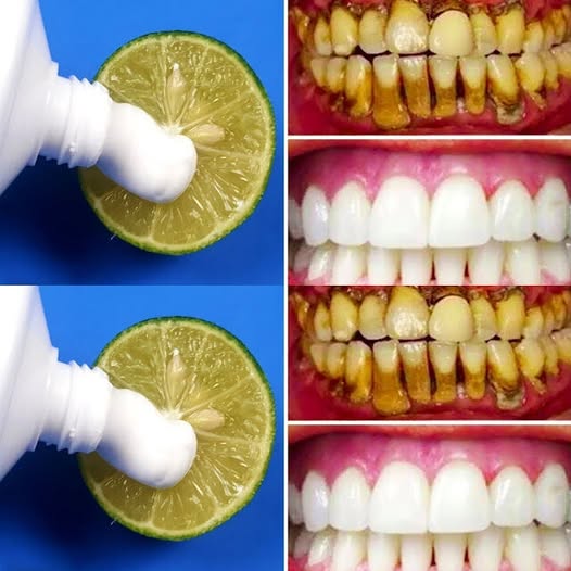 Brighten your smile naturally: The two-minute lemon whitening method