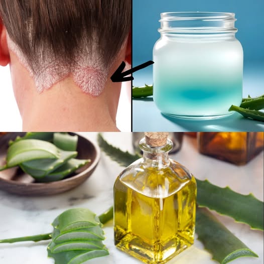 Miracle oil eliminates psoriasis, eczema, and dermatitis! Discover the secret to healthy skin – Aloe Vera Oil