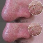 The 5 most effective ways to get rid of blackheads in no time!!