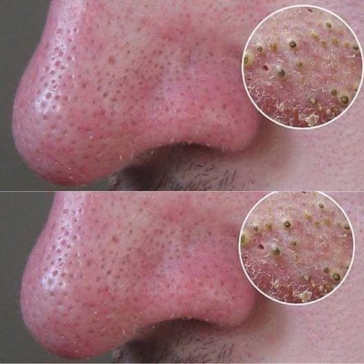 The 5 most effective ways to get rid of blackheads in no time!!