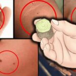 Natural skin care: What can you try to remove age spots, moles, skin tags, warts, and blackheads?