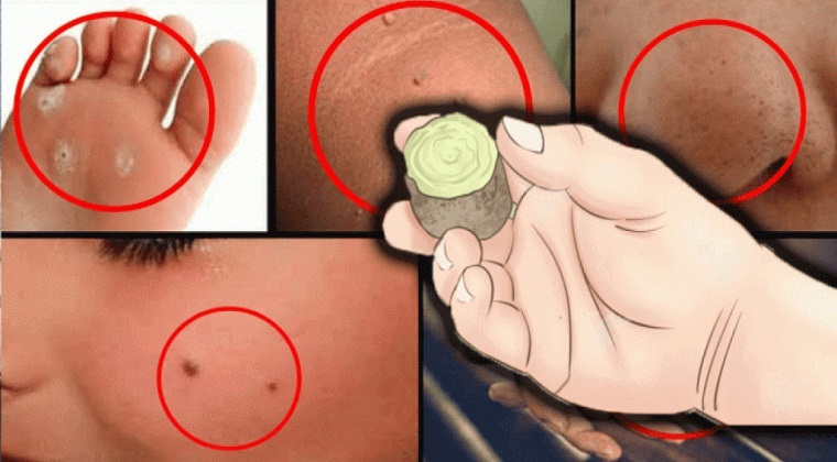 Natural skin care: What can you try to remove age spots, moles, skin tags, warts, and blackheads?