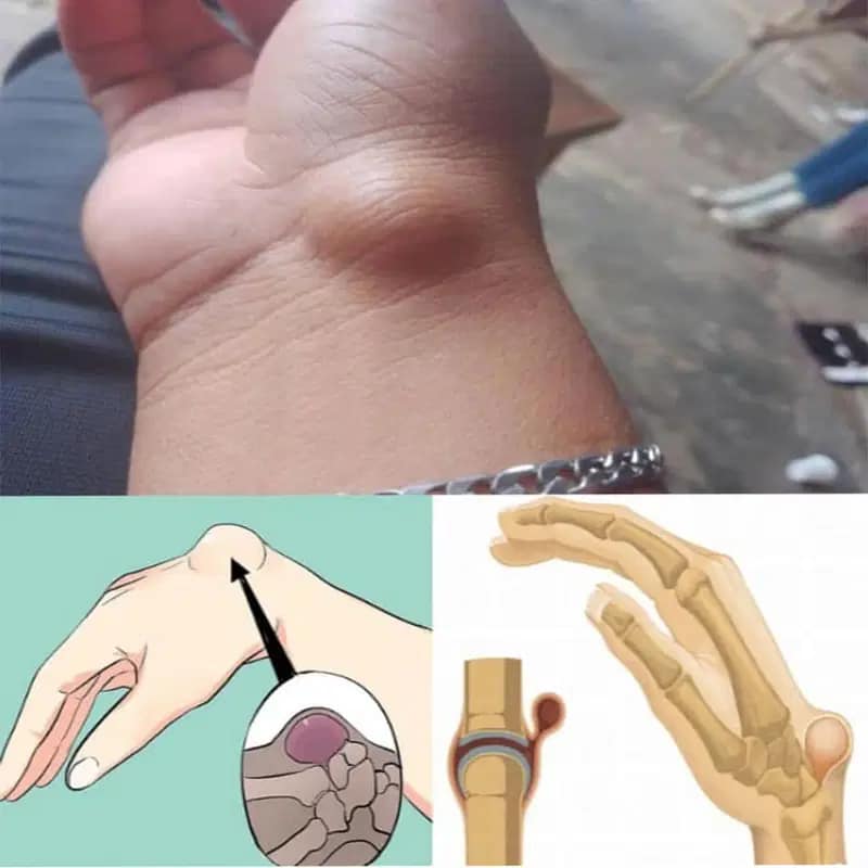 Ganglion wrist: causes, symptoms and treatments.