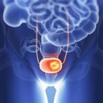 10 signs of bladder cancer to look out for