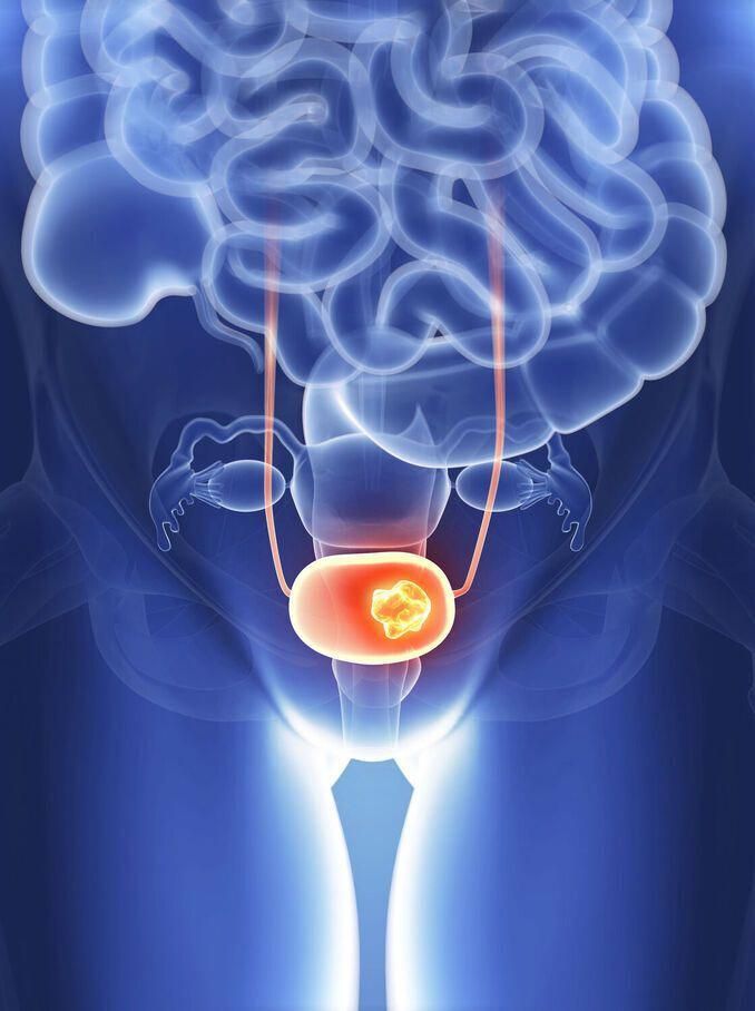 10 signs of bladder cancer to look out for