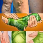 Amazing! Get Rid of Varicose Veins – Just Put These Leaves Over and Wait!