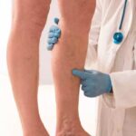 Thrombosis, a silent disease that can be fatal. What are the symptoms?