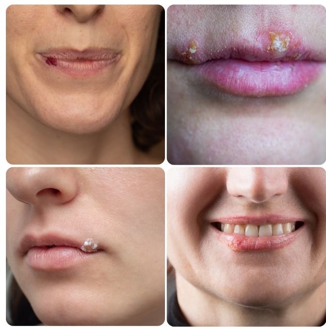 Most people have had or have had this cold sore virus, but very few know how to cure it. What you should do is: