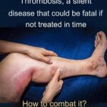 What is afraid of varicose veins: effective folk methods of treatment