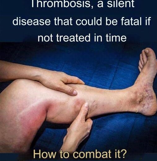What is afraid of varicose veins: effective folk methods of treatment