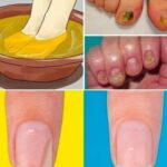 THE FUNGUS DISAPPEARS ON THE FEET AND HANDS FROM THIS MIXTURE! WORTH REPLACEMENT OF EXPENSIVE PHARMACY OINTMENTS!