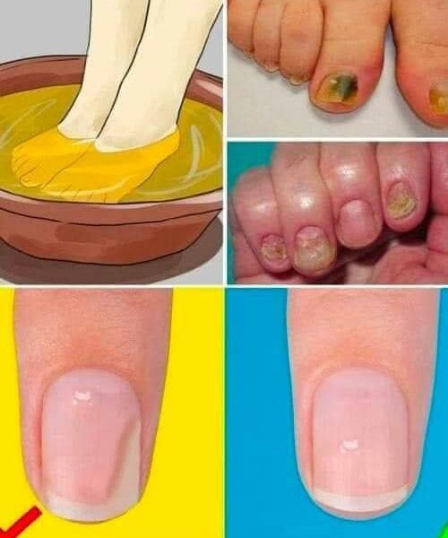 THE FUNGUS DISAPPEARS ON THE FEET AND HANDS FROM THIS MIXTURE! WORTH REPLACEMENT OF EXPENSIVE PHARMACY OINTMENTS!