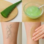 Say goodbye to varicose veins and heavy legs with just this: 100% effective aloe vera leaf