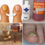 Nail fungus: how to get rid of them in a few days and naturally