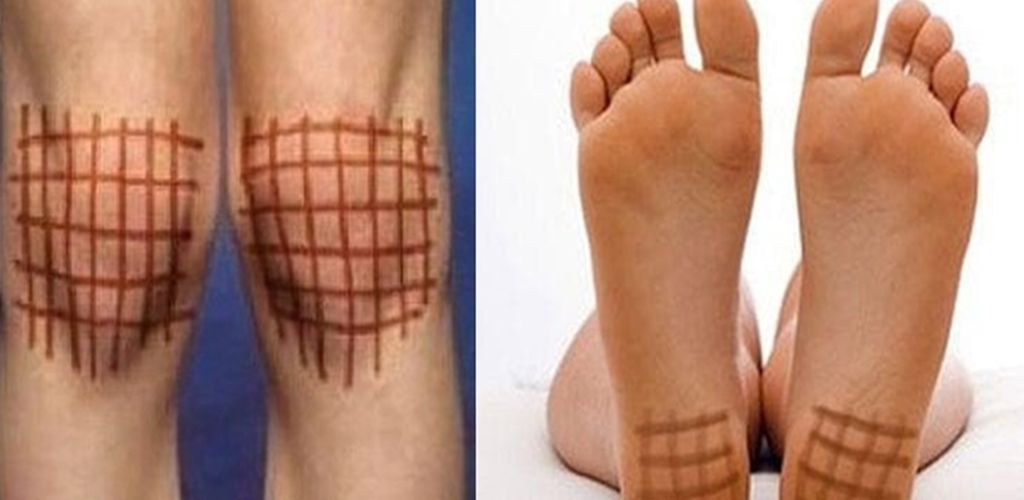 Get rid of various joint and seasonal diseases by painting with iodine on your knees, chest, back, and heels!