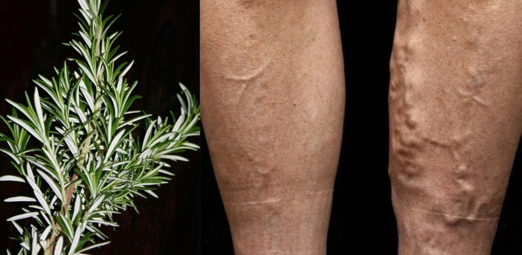 This is a green gift from God, my grandmother used to say: SALVATION for sore legs, it helps with varicose veins and swelling!