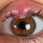 Styes on the eye: Discover natural remedies to relieve discomfort and speed healing.