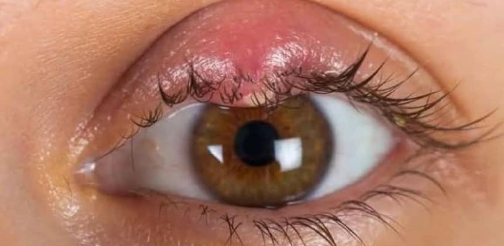Styes on the eye: Discover natural remedies to relieve discomfort and speed healing.