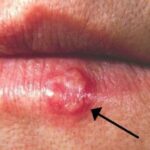 Most people have had or have this cold sore virus, but very few know how to cure it. What you should do is.