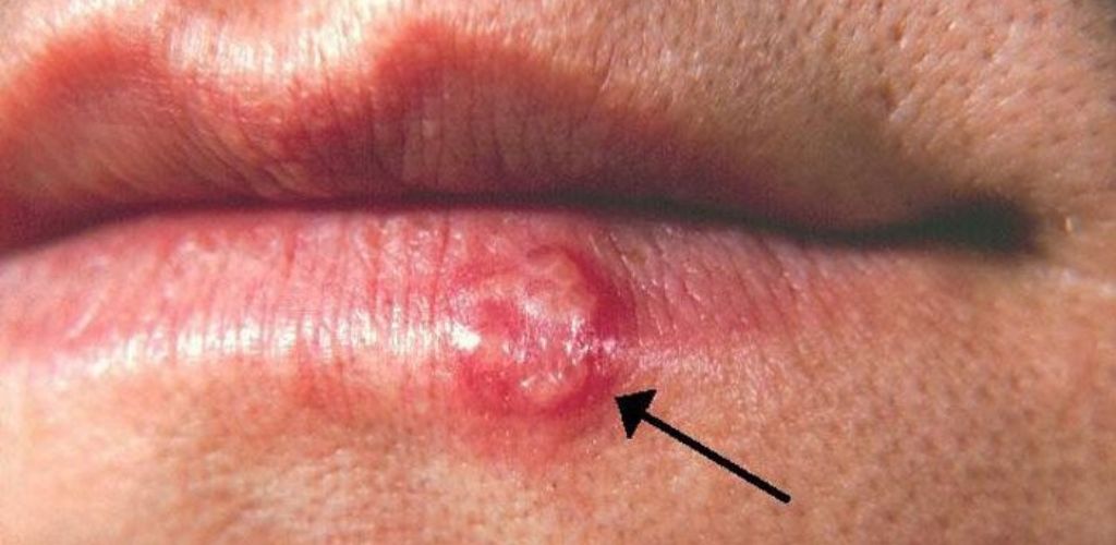 Most people have had or have this cold sore virus, but very few know how to cure it. What you should do is.