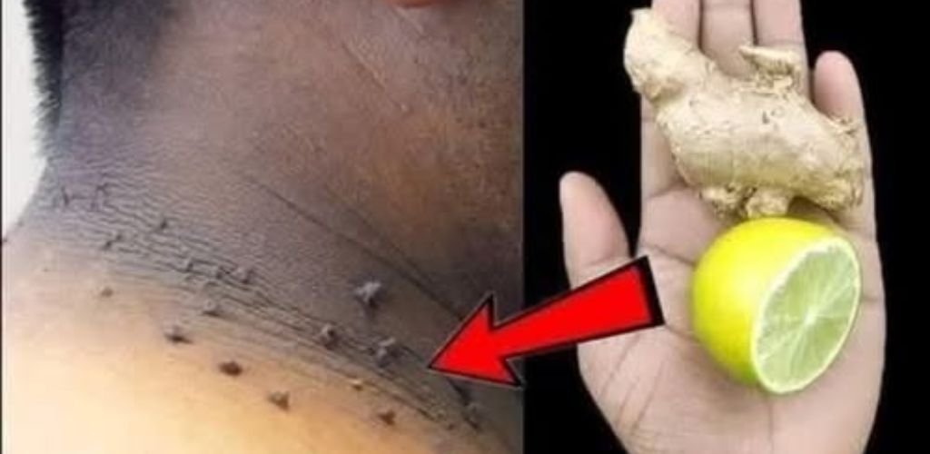 Get rid of pimples, spots, warts just by using ginger