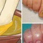 Try these natural remedies and say goodbye to nail fungus