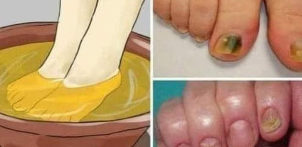 Try these natural remedies and say goodbye to nail fungus