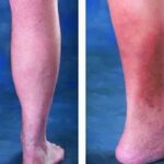 How to get rid of varicose veins permanently: tips and tricks