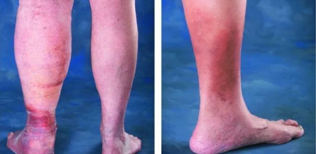 How to get rid of varicose veins permanently: tips and tricks