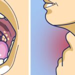 Get rid of painful swallowing and sore throat.