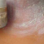 How to Eliminate Dark Areas on the Neck, Armpits and Thighs in Just 15 minutes?