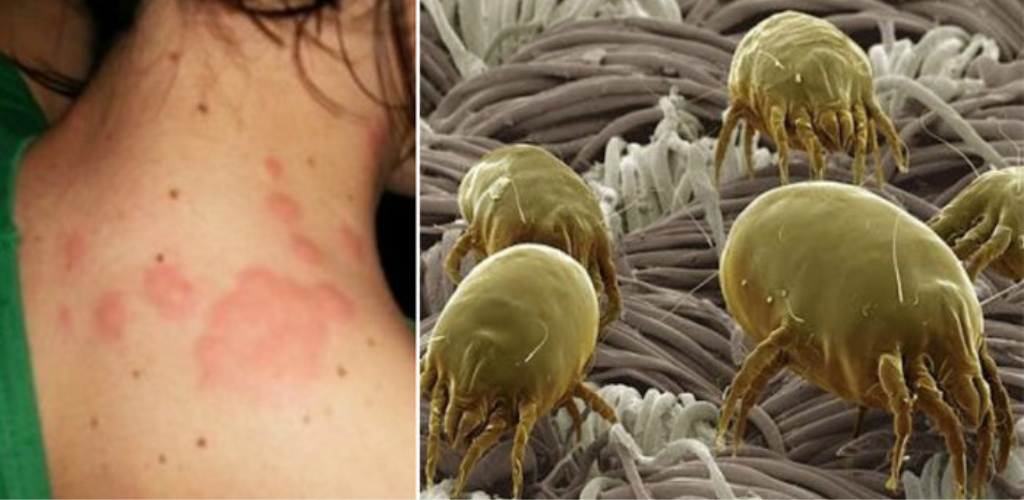 Don’t let the mites in your bed and clothes eat you alive! Spray this on them and you’ll never hear from them again.
