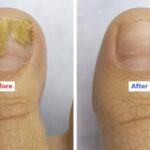 Say Goodbye to Weak Nails and Fungus—Forever: Discover the Power of Natural Nail Care