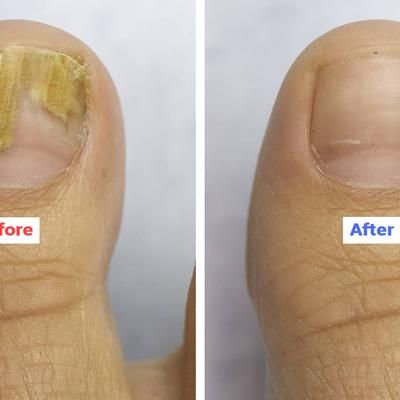 Say Goodbye to Weak Nails and Fungus—Forever: Discover the Power of Natural Nail Care