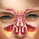 Get rid of a runny nose, sinusitis, cough, in just 24 hours